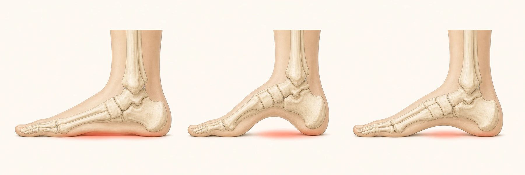 Side-profile anatomy of low, high and neutral foot arches